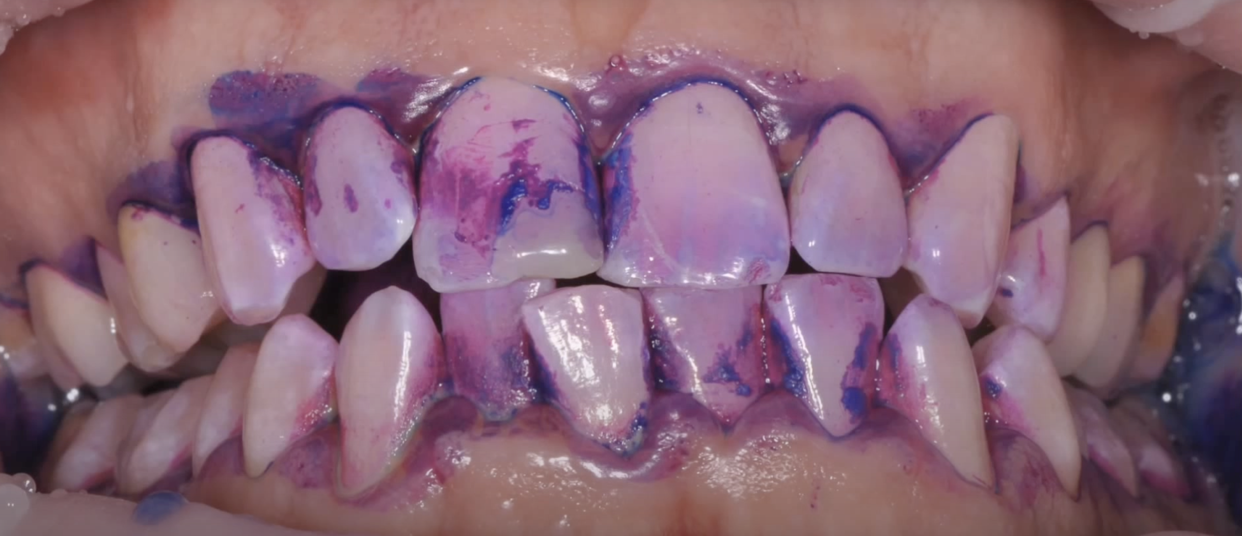 Biofilm disclosing dye showing areas to clean