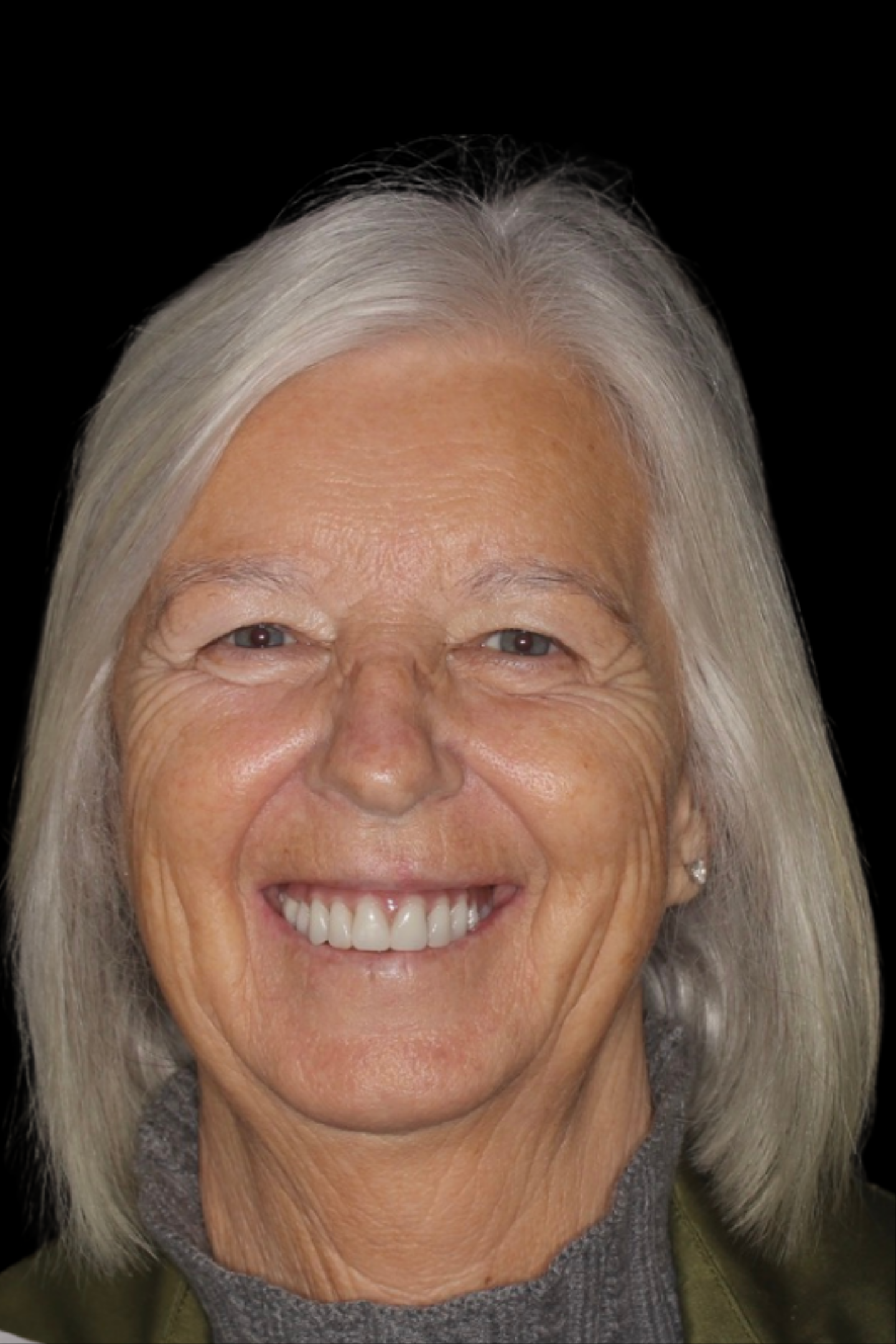 After: full-arch dental implants