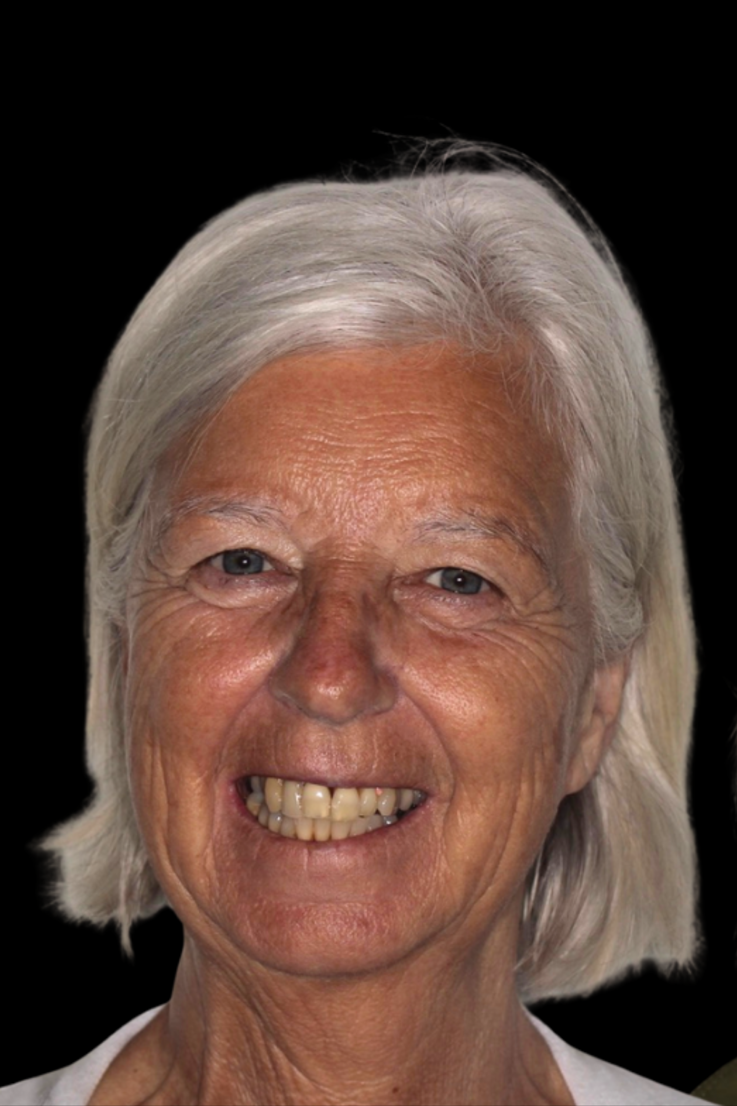 Before: full-arch dental implants