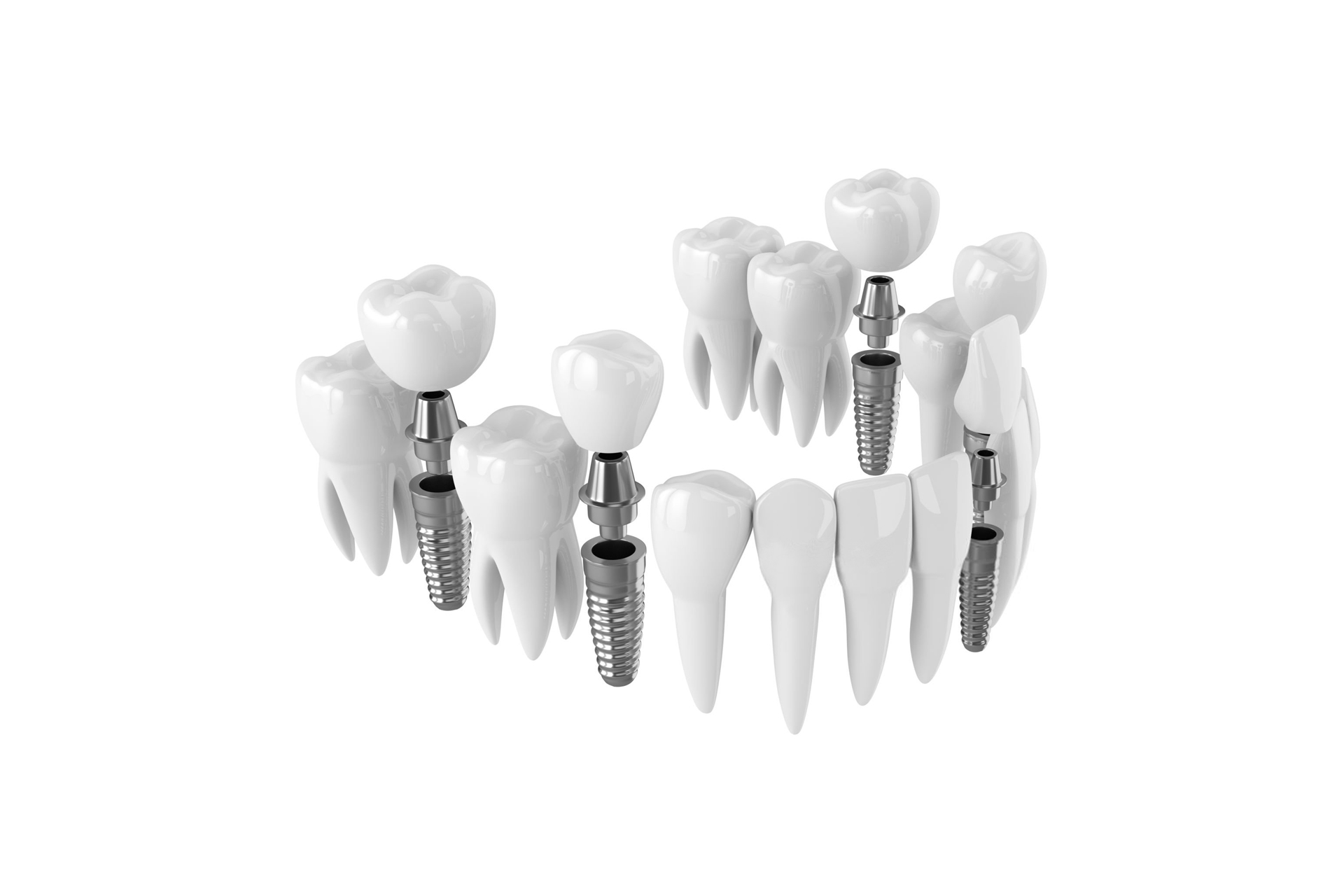 Dental implant illustration