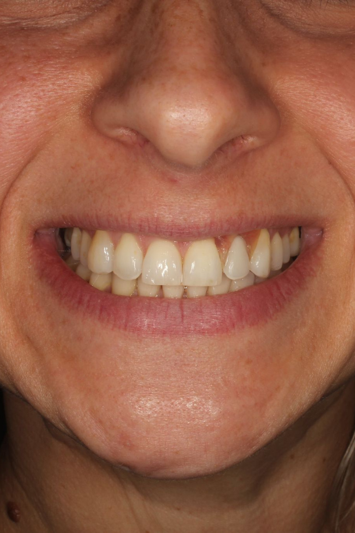 After: single-tooth dental implant