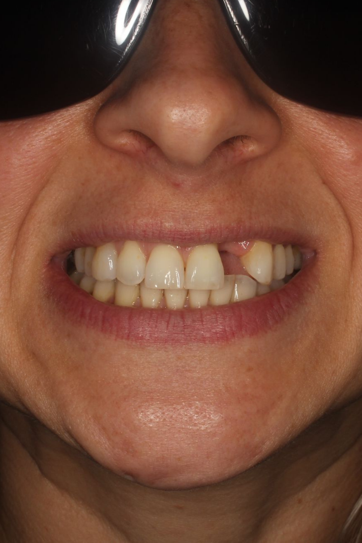 Before: single-tooth dental implant