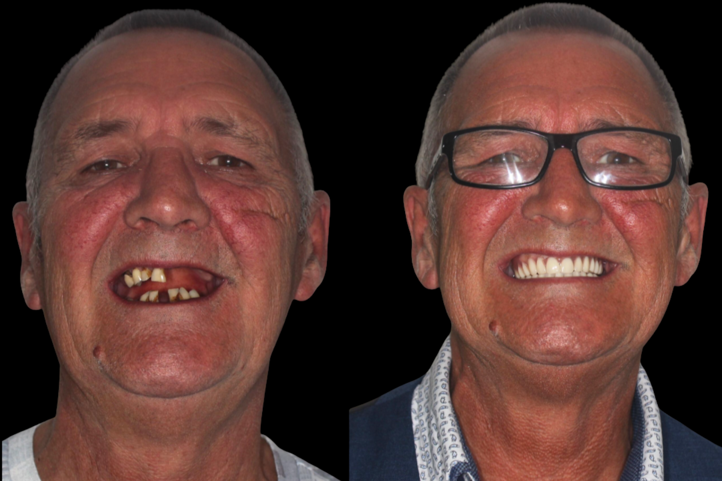 Dental implants before and after - Smile Showroom (case 1)