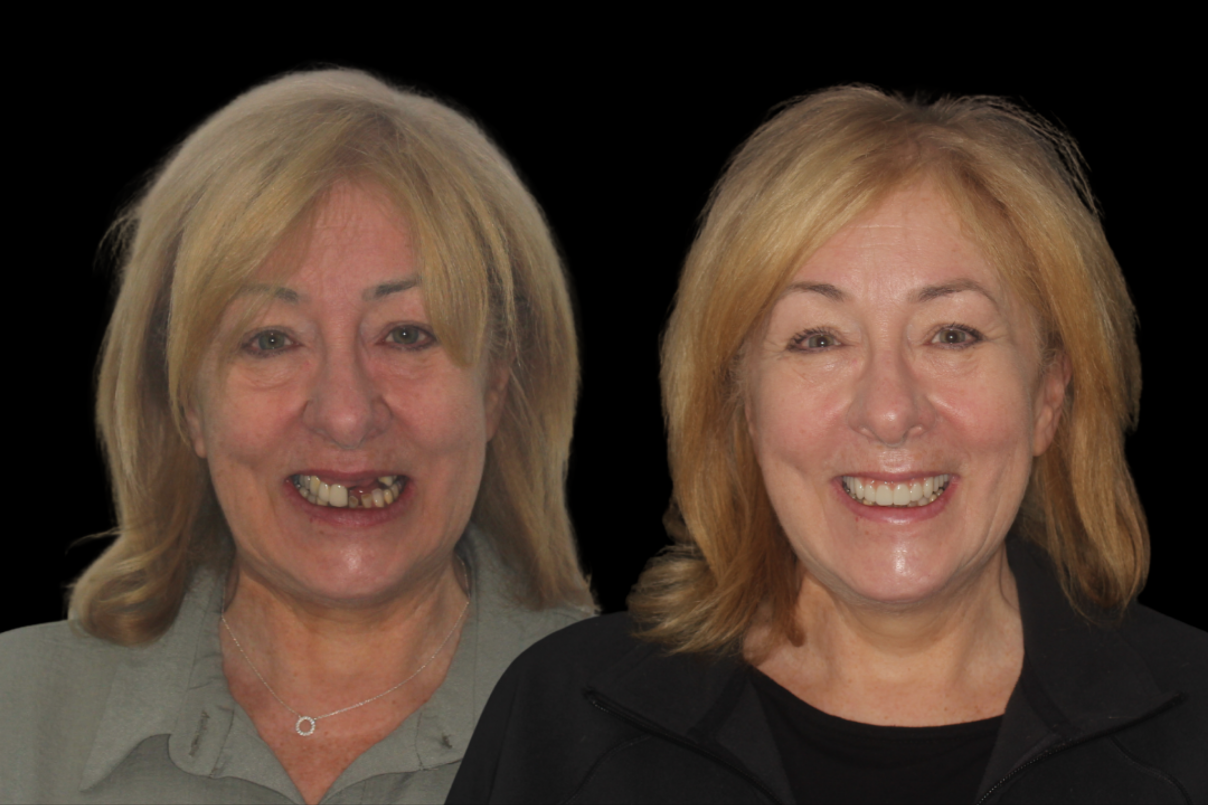 Precision shade and fit for implant crowns