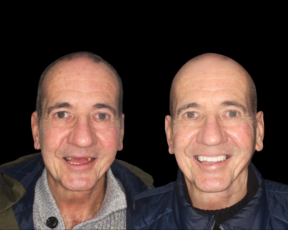 Digital planning & guided surgery