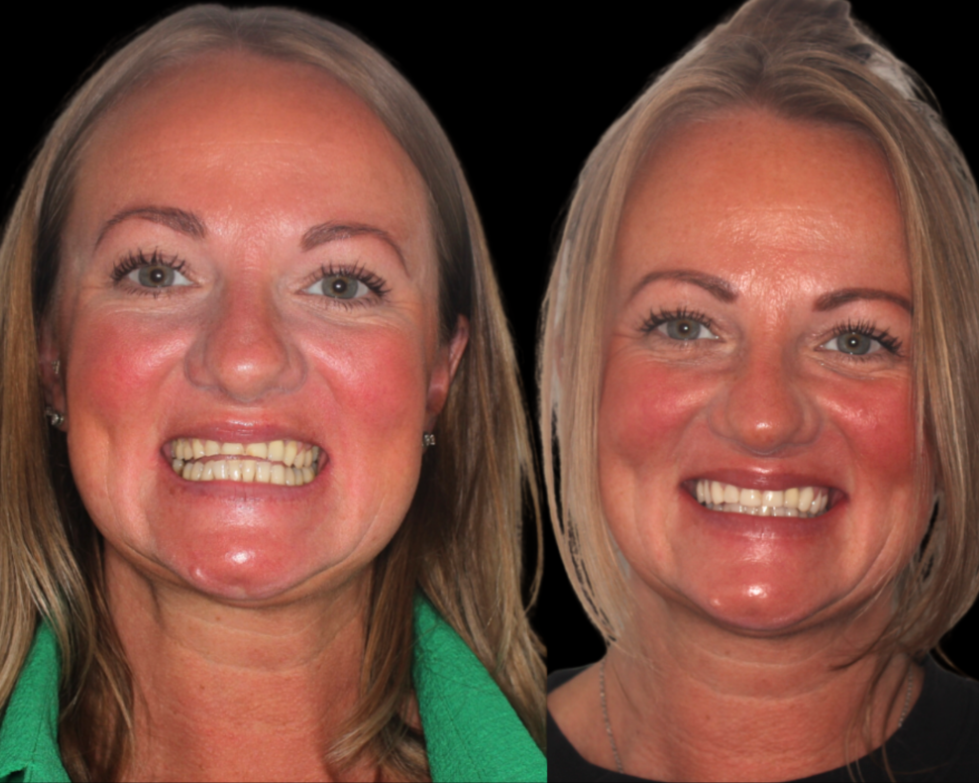 Ultra-clean composite finish