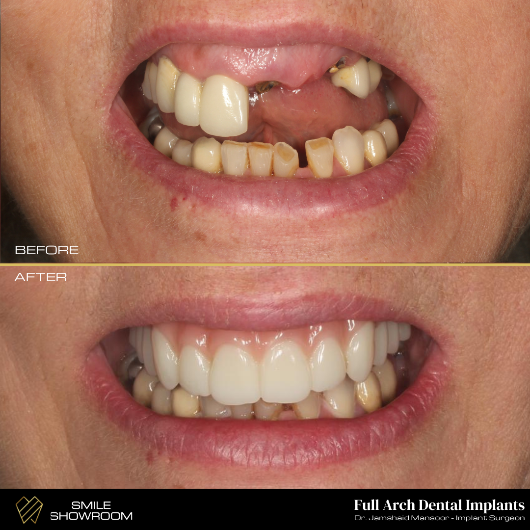 Full arch dental implants transformation before and after
