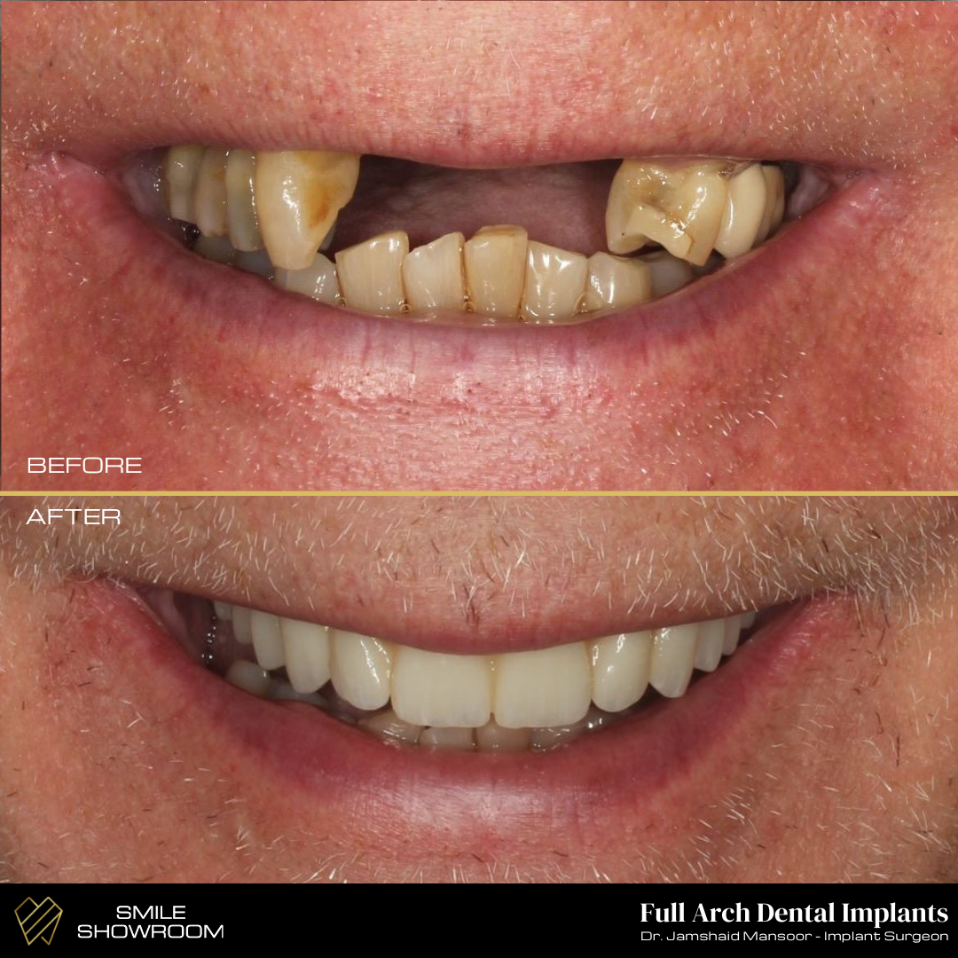 Full arch dental implant restoration before and after