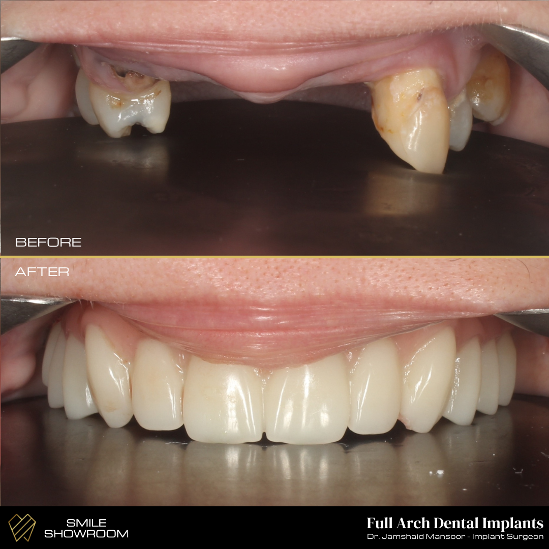 Full arch dental implants before and after