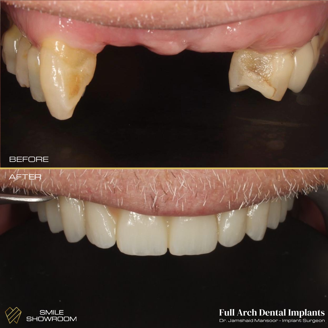Full arch implants before and after result