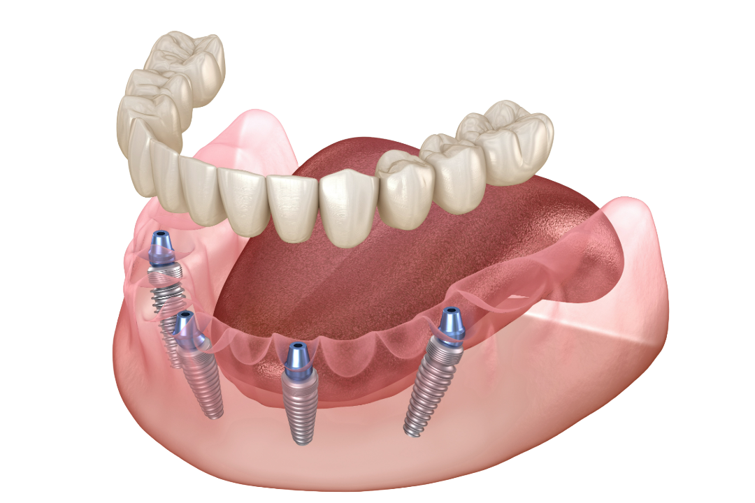 All-on-4 dental implants