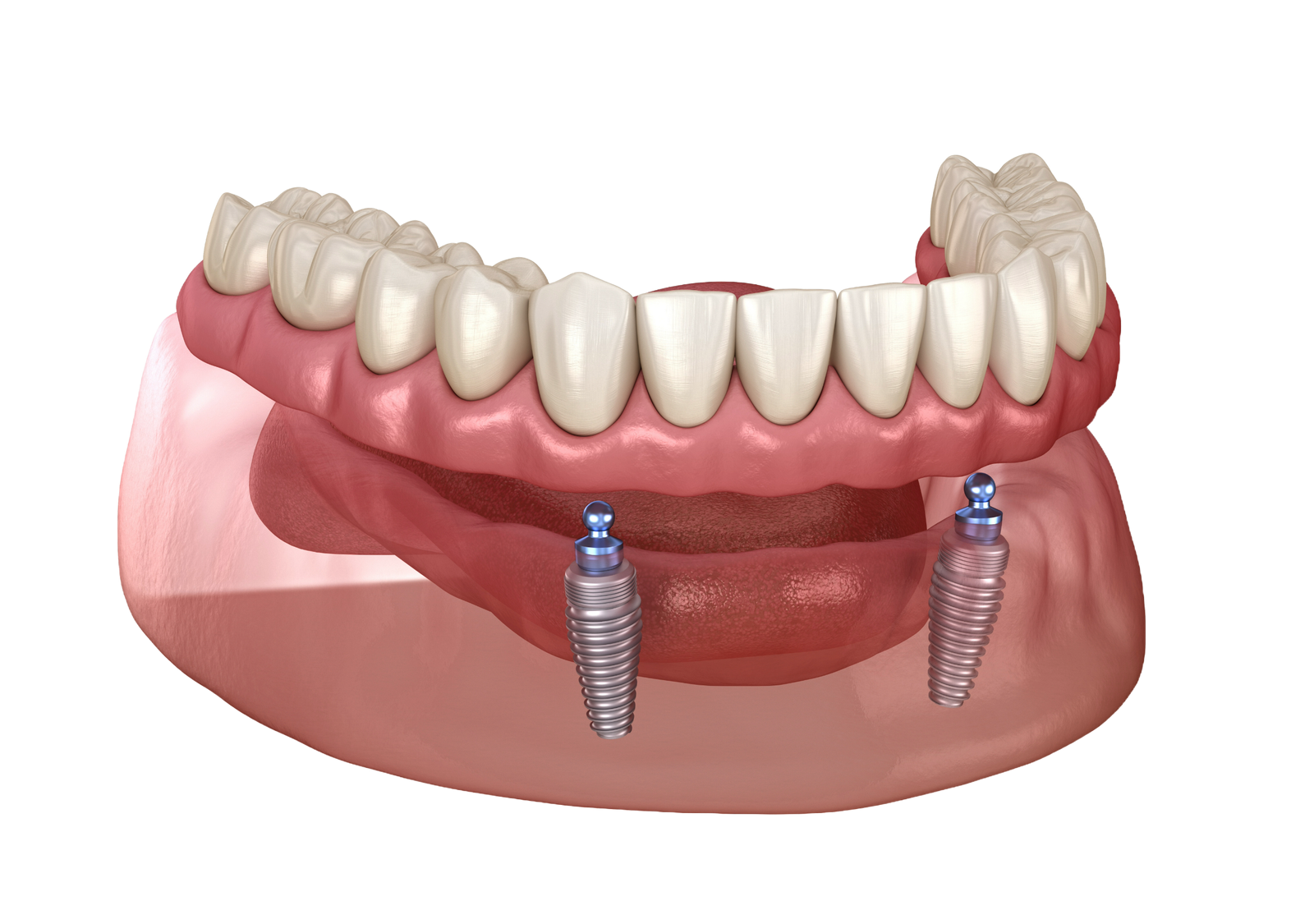 Implant retained dentures
