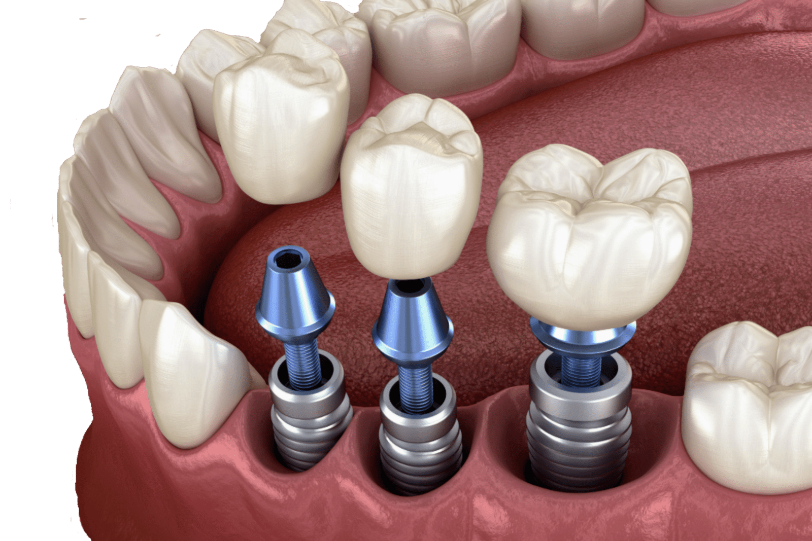 Multiple dental implants