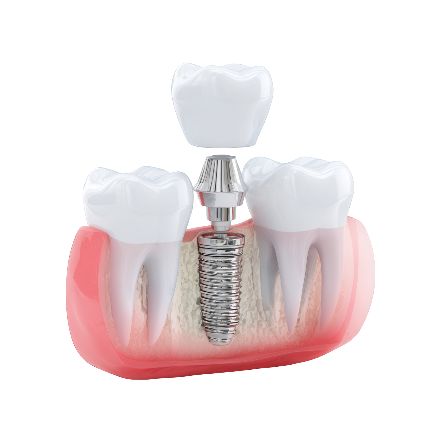 Single tooth implant